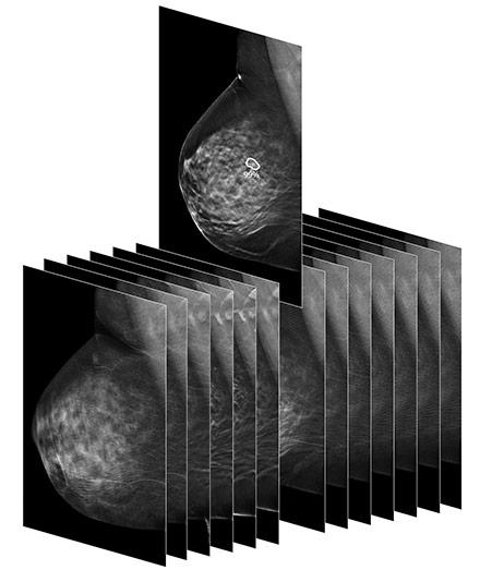 Artificial Intelligence Mammograms