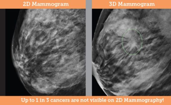 2D Mammography